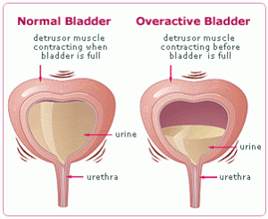 Bladder retraining