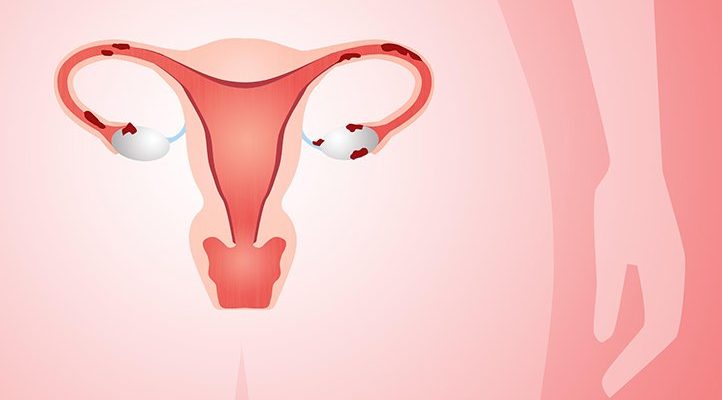 Endometriosis: Myth Busters